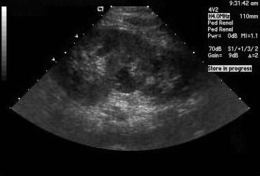 Longitudinal sonogram of the left kidney in an 18-