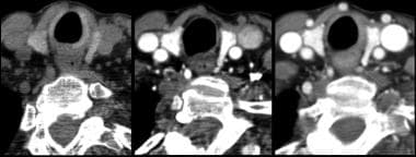 Axial CT images in noncontrast (A) early post-cont