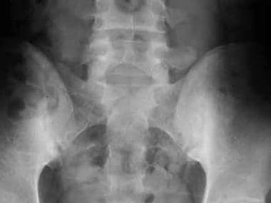 Bilateral sacroiliitis. Frontal radiograph shows b