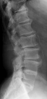 Radiograph of the lumbosacral spine (lateral view)