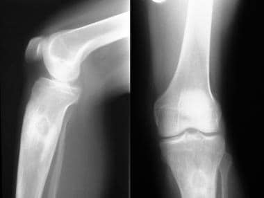 Osteomyelitis, chronic. Plain radiographs show Gar