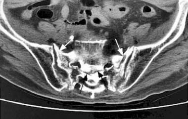 Axial CT of the sacrum reveals insufficiency fract