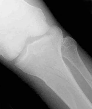 Tibial plateau fractures. Radiograph of the knee s