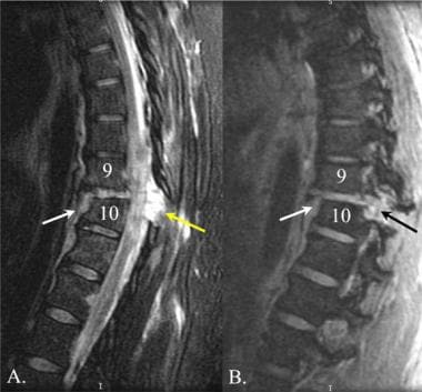 Thoracic spine trauma. Sagittal MRIs of the thorac