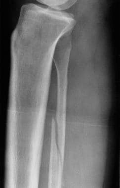 Lateral radiograph in a patient with Maisonneuve i