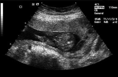 Marginal placental hemorrhage: Ultrasonographic im