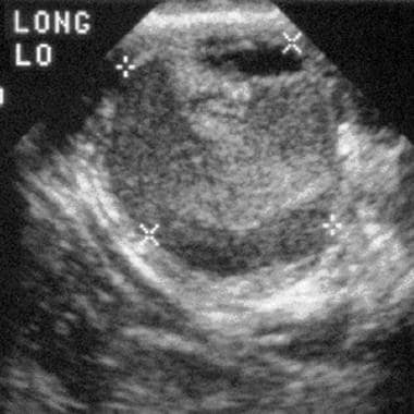 Transverse view of a left ovarian endometrioma sho