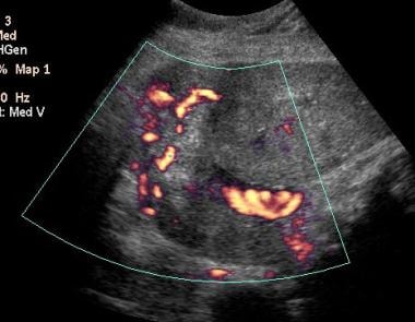 Color Doppler scan in a 21-year-old woman in 33rd 