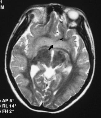 Corpus callosum, agenesis. Axial T2-weighted MRI o