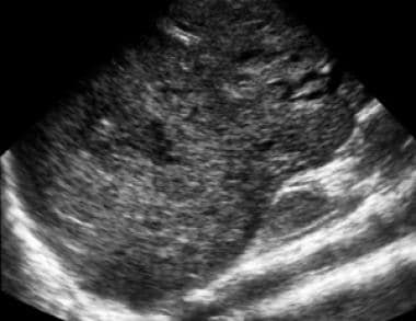 Longitudinal ultrasound image of the right lobe of