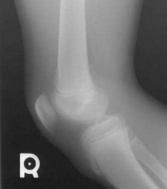 Lateral radiograph of the left tibia demonstrating the characteristic