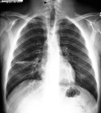 Posteroanterior (PA) chest radiograph shows defect