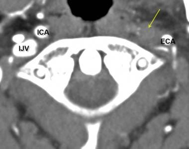 Carotid artery, stenosis. Axial image of a carotid