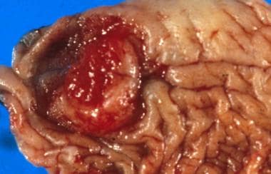 Squamous cell carcinoma of the prepuce: The ulcera