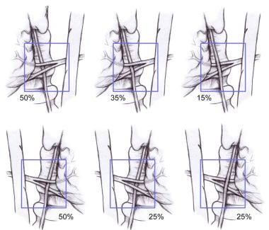 Relationship of the recurrent laryngeal nerve (RLN