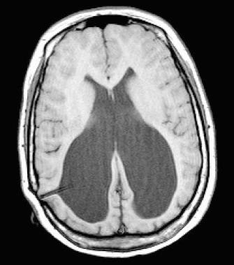 Axial T1-weighted MRI scan of a 15-year-old girl w