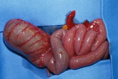 Gross example of colonic atresia. 