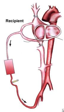 Outcomes After Transplantation of Donor Hearts With Improving Left  Ventricular Systolic Dysfunction