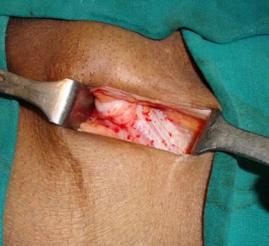 Open inguinal hernia repair. External oblique apon