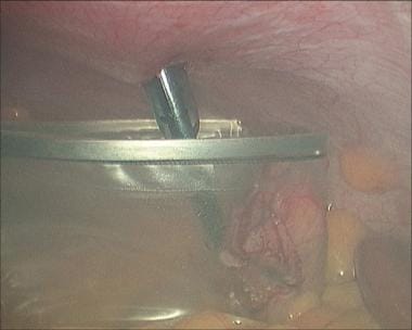 Laparoscopic cholecystectomy. Placement of gallbla