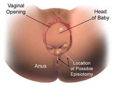 Episiotomy and Repair Background Indications Contraindications