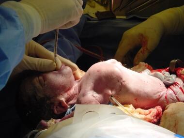 Intubation during ex-utero intrapartum treatment (