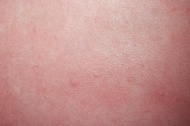 cholinergic urticaria