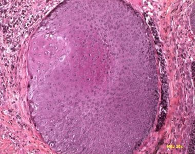 Multiple pilomatricomas in twins with Rubinstein-Taybi syndrome