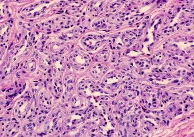 Histopathology of a proliferating infantile hemang