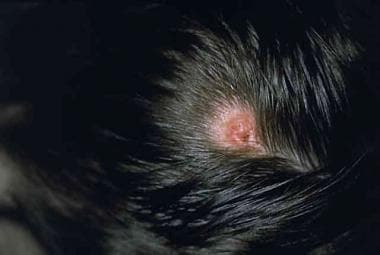 This photograph of lymphocytoma cutis caused by an
