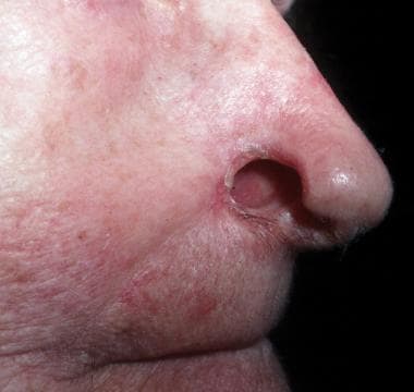 A nasal defect after excision of squamous cell car