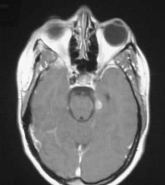 Meningioma to the left of midline in a patient wit