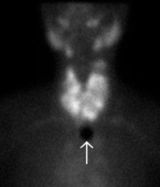 Technetium-99m (99mTc) thyroid scan of a large, no