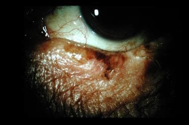 melanoma on eyelid