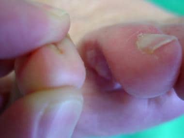 Fifth-toe deformities. Example of kissing corns. M