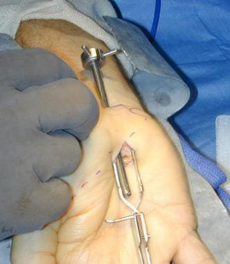 Cannula is inserted inside carpal space, with groo