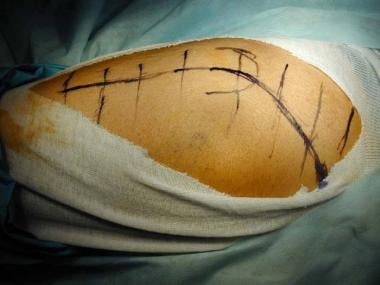 Incision for the Kocher-Langenbeck approach. 