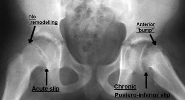 Bilateral slipped capital femoral epiphysis. One s