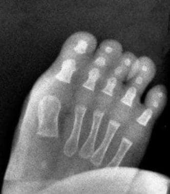 Postoperative radiograph of a 1-year-old child wit