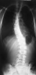 Idiopathic Scoliosis