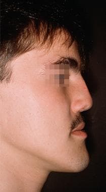 Proplast nasal grafts. A 20-year-old man with a po