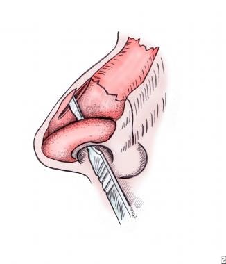 Basic closed technique for rhinoplasty. Illustrati