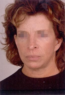 Frontal view 11 months after a subcutaneous skin-o