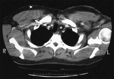 Postchemotherapy computed tomography scan in a pat