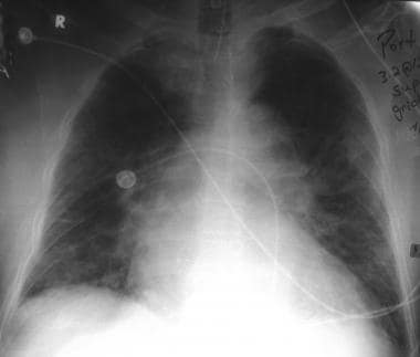 Radiograph shows acute pulmonary edema in a patien