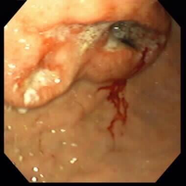 Peptic ulcer disease. Gastric cancer with an ulcer