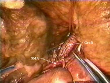 Antegrade bypass from aorta to superior mesenteric