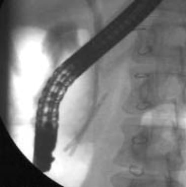 Pediatric Pancreatitis. In this radiograph from th
