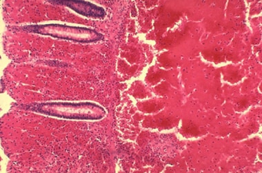 Histopathology of large intestine showing marked h
