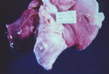 Childhood polyarteritis nodosa. Heart with 5 coron
